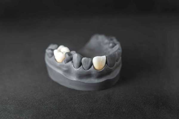 Avez-vous des solutions pour les dents manquantes ?