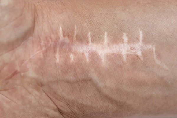 Cicatrice cheloïde : guide pratique pour un traitement réussi